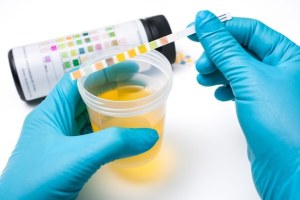 Doctor s perform urine test to diagnose lupus