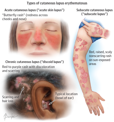 Types of cutaneous lupus